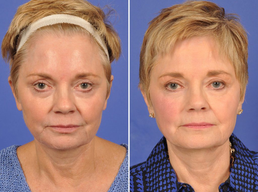 Mid Facelift Before After