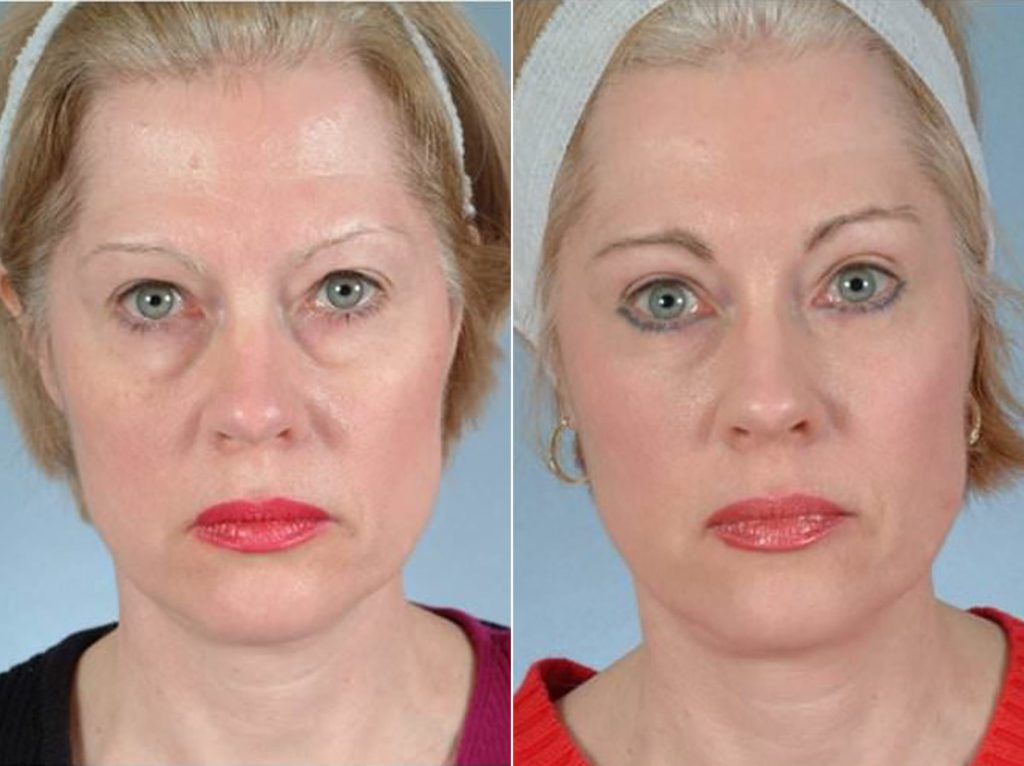 Mid Facelift Before After