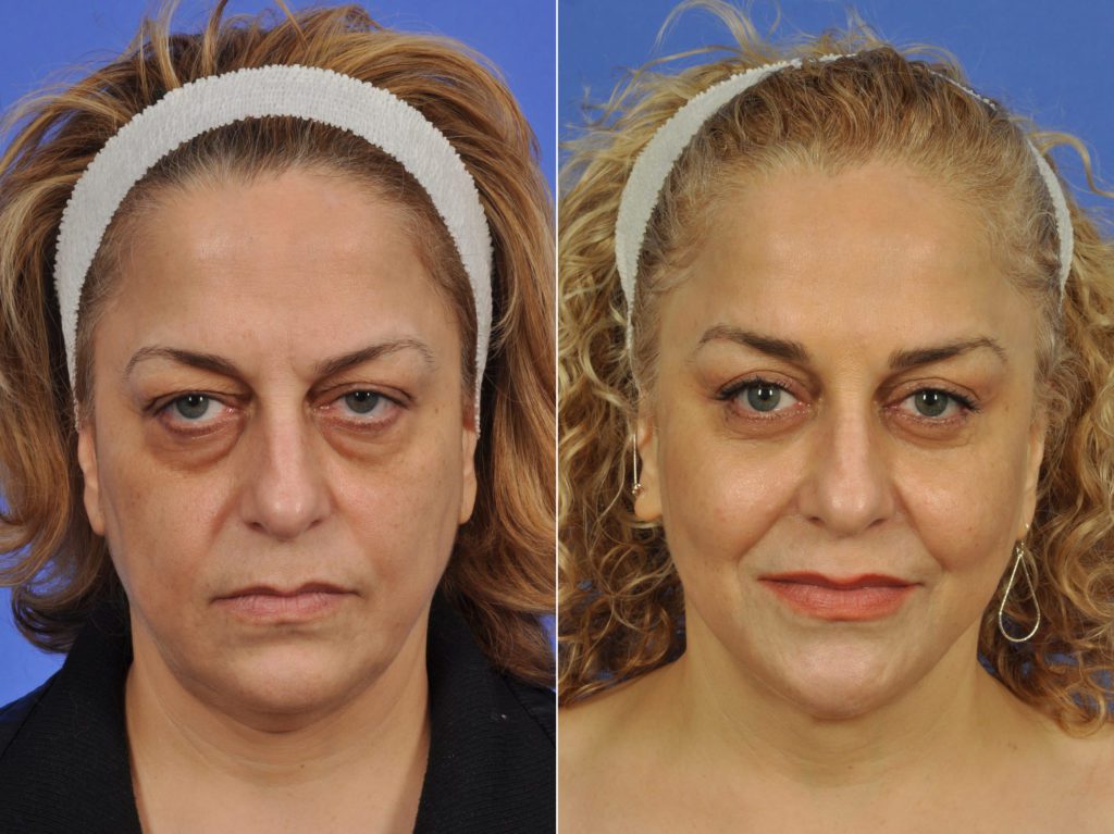 Mid Facelift Before After