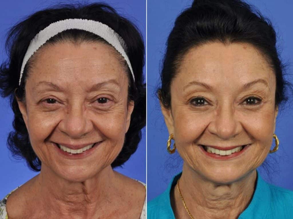 Mid Facelift Before After