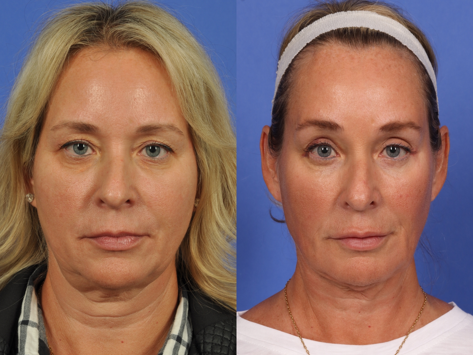 Mid Facelift Before After