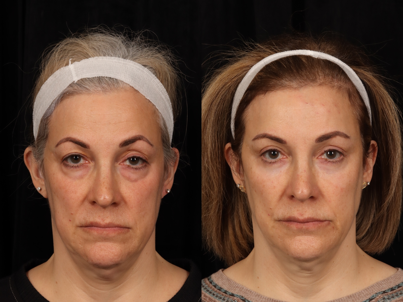 Mid Facelift Before After