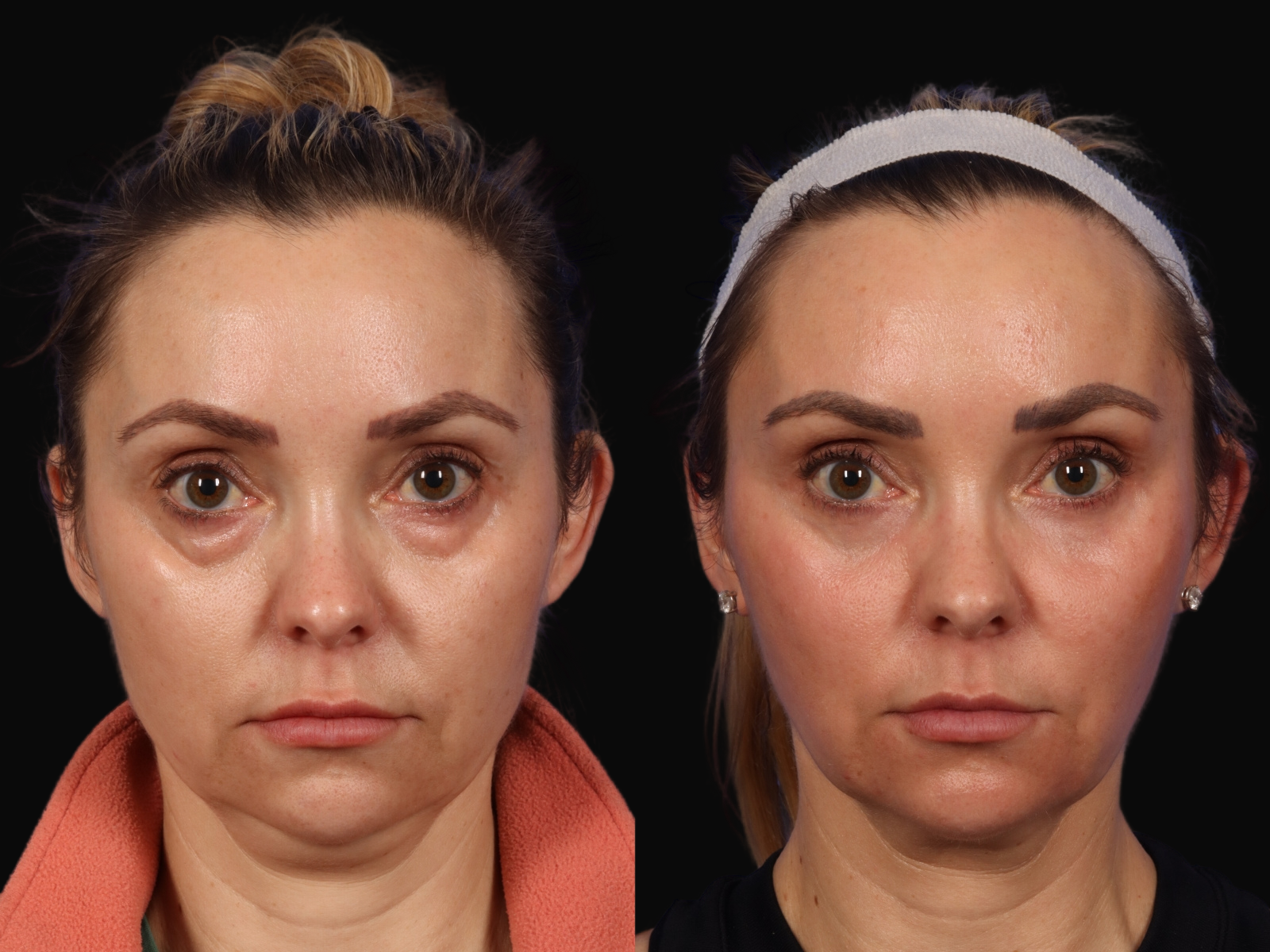 Mid Facelift Before After