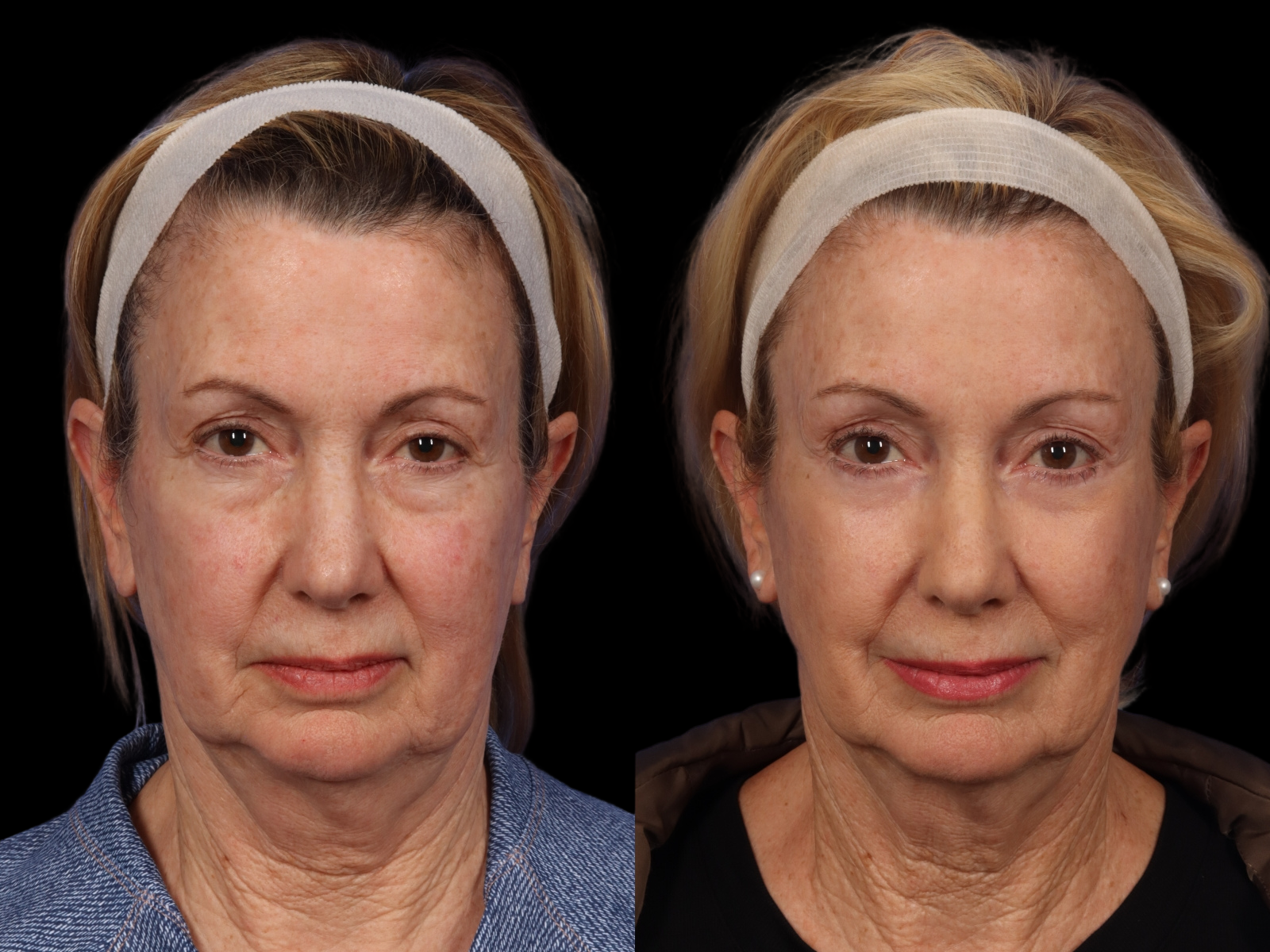 Mid Facelift Before After