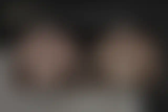 Riduzione di areola e capezzolo sul torace di un uomo, viste frontali prima e dopo, con un braccio tatuato nell'inquadratura.