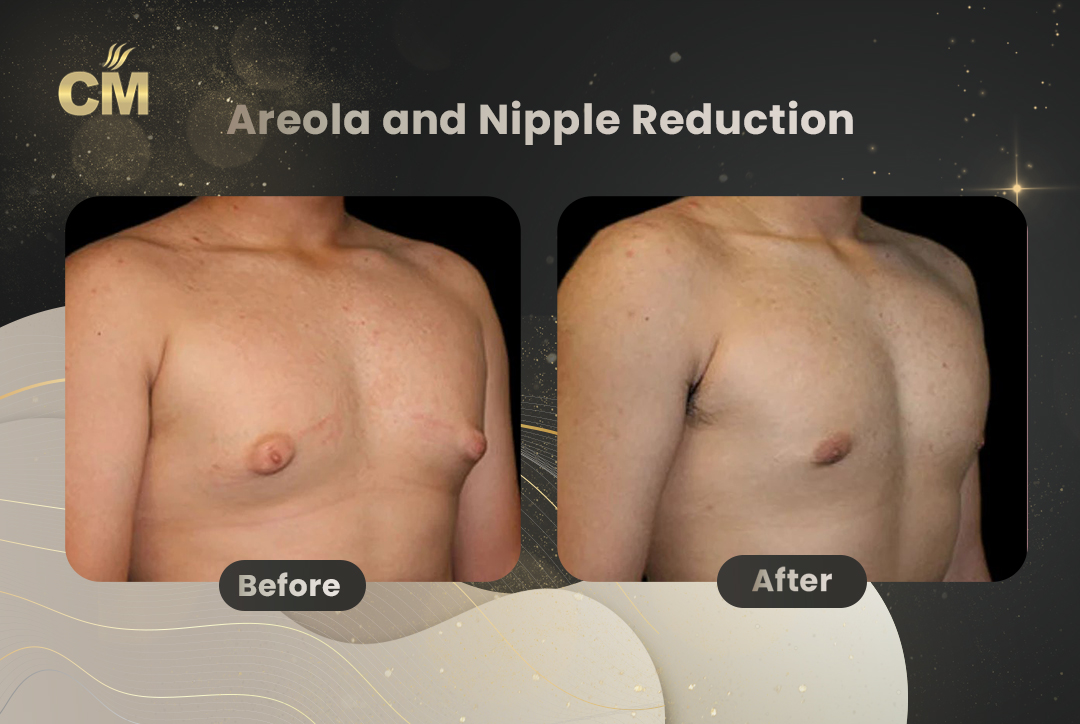 Areola and Nipple Reduction Before After-1