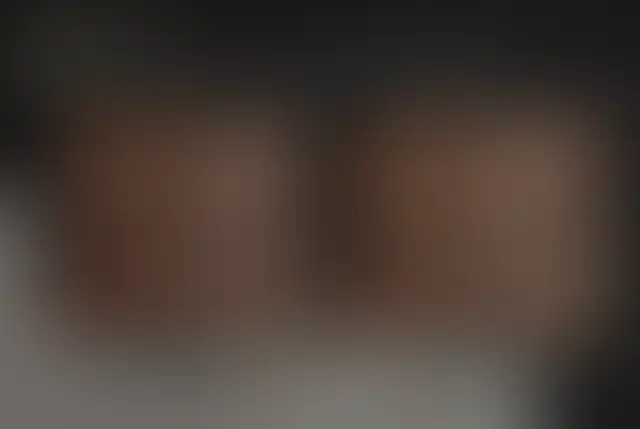 Photographie masquée d’un patient ClinMedica avant et après l’intervention