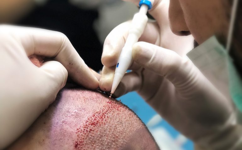 Apertura dei canali durante il trapianto di capelli DHI in Turchia