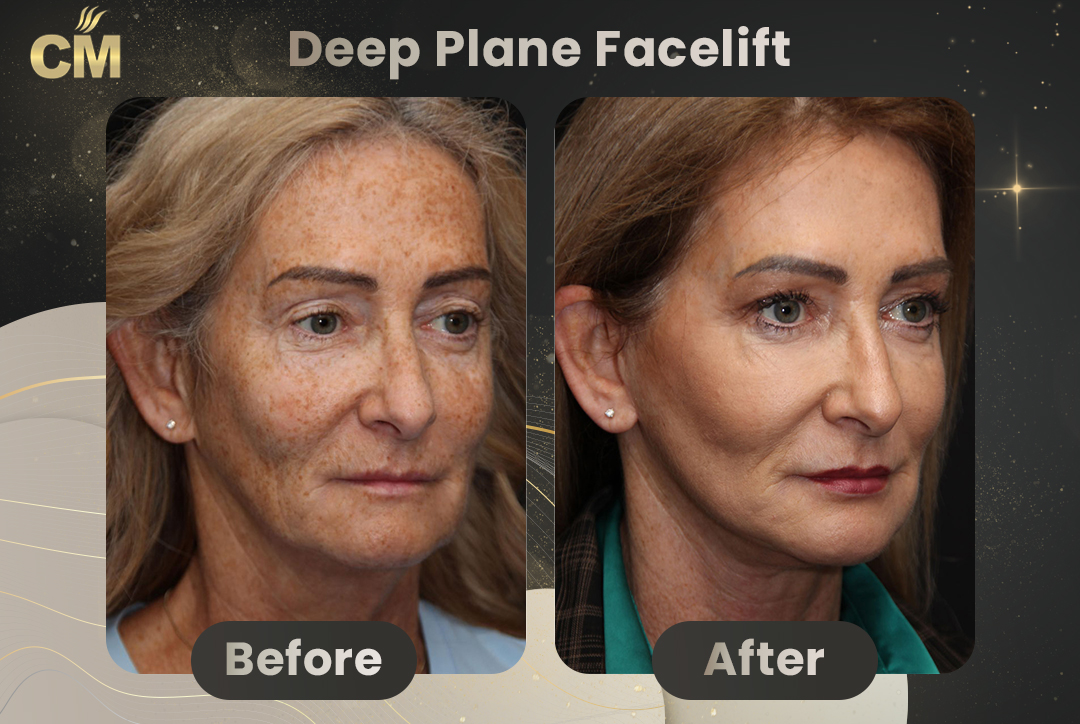 Deep Plane FaceLift Before After