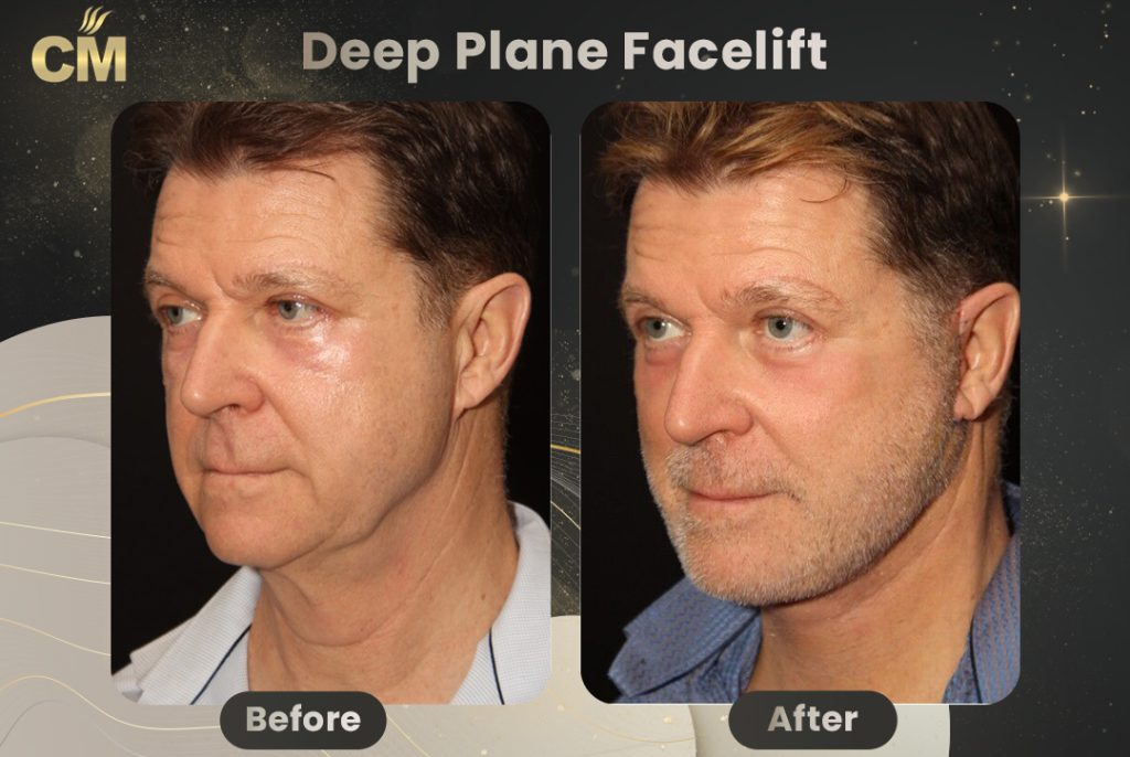 Deep Plane Facelift Before And After Results deep-plane-facelift-before-and-after-results