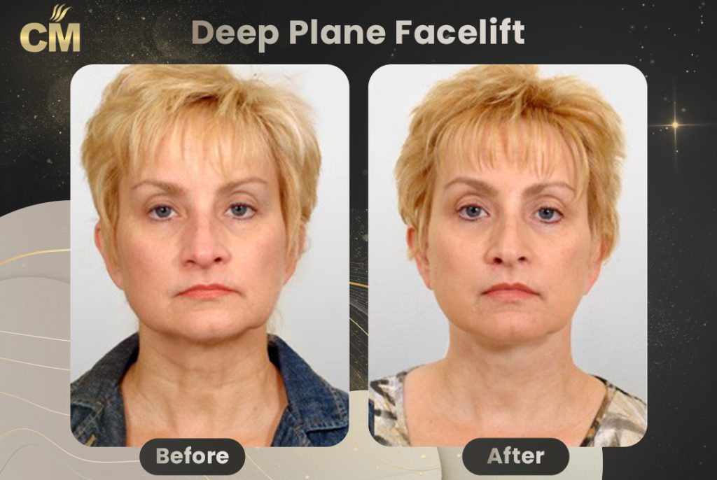 Deep Plane Facelift Before And After Results deep-plane-facelift-before-and-after-results