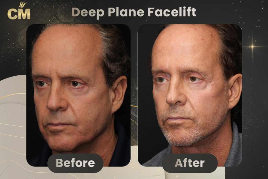 Deep Plane Facelift Before And After Results deep-plane-facelift-before-and-after-results