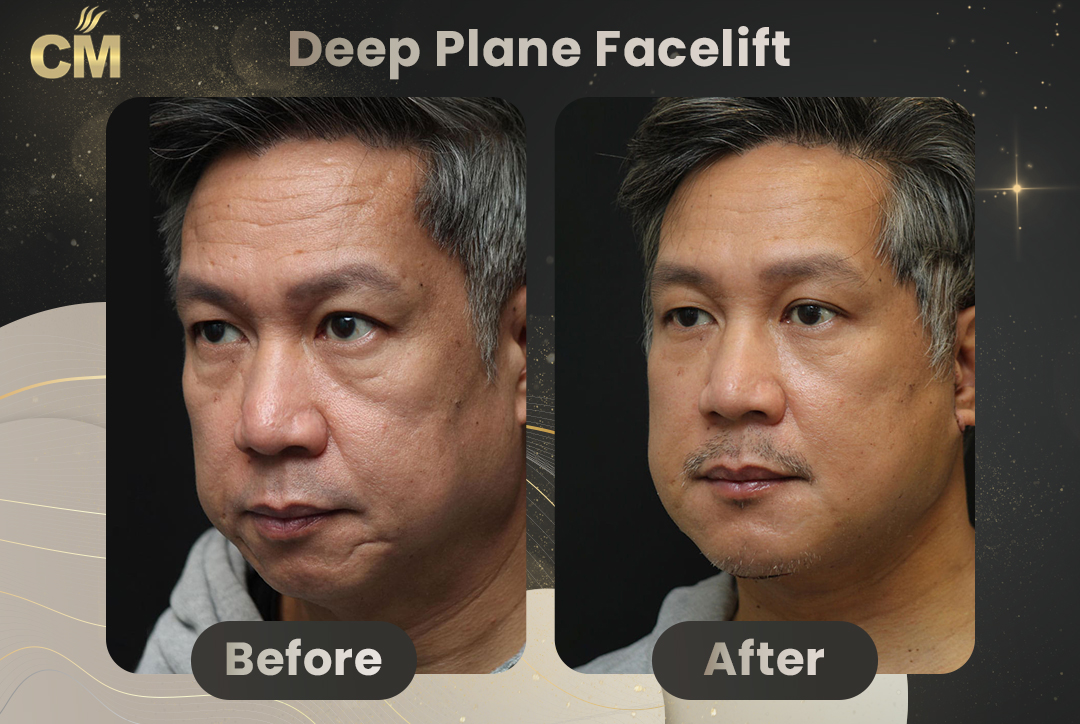Deep Plane FaceLift Before After-1