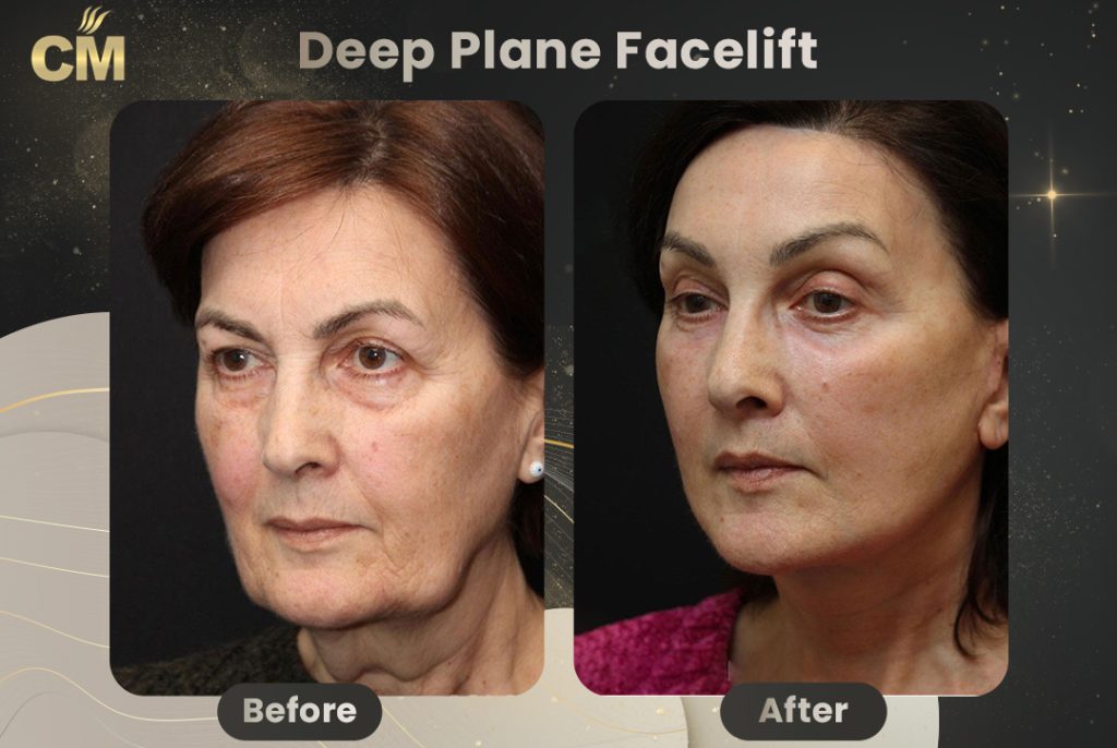Deep Plane Facelift Before And After Results deep-plane-facelift-before-and-after-results