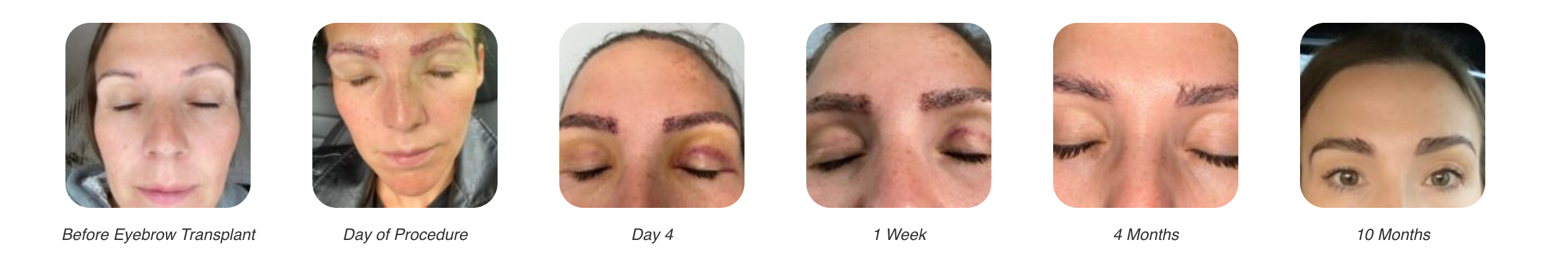 Eyebrow transplant timeline
