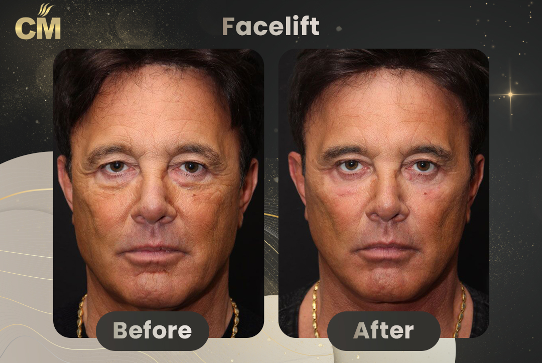Facelift Before and After-9