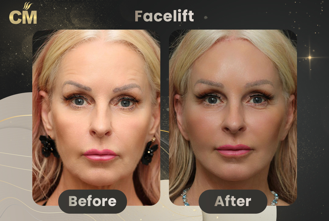 Facelift Before and After-7