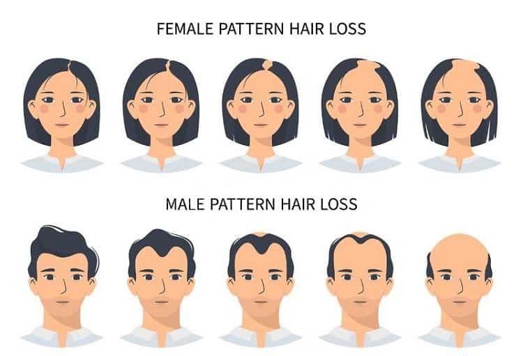 Affrontare i problemi di calvizie ereditaria nel trapianto di capelli in Turchia