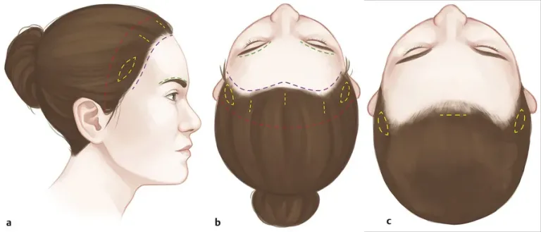 Il lifting della coda di cavallo tacchino 1