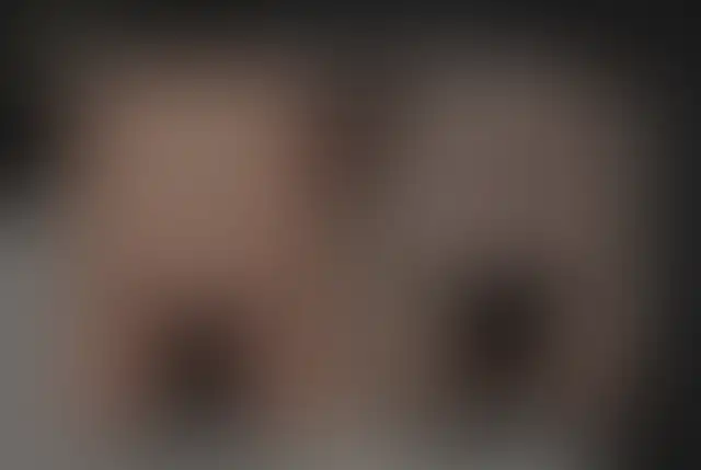 Photographie masquée d’un patient ClinMedica avant et après l’intervention