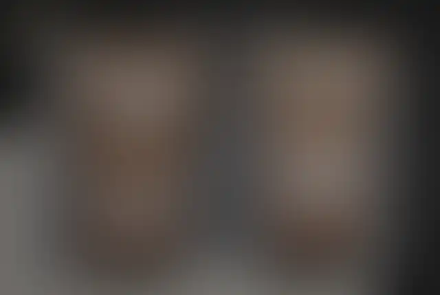 Photographie masquée d’un patient ClinMedica avant et après l’intervention