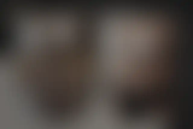 Photographie masquée d’un patient ClinMedica avant et après l’intervention
