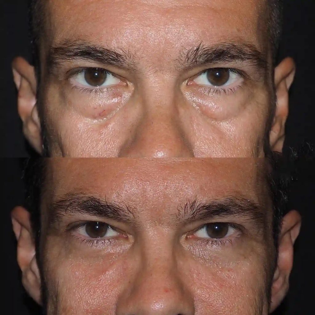 Blepharoplasty Before and After in Turkey-2