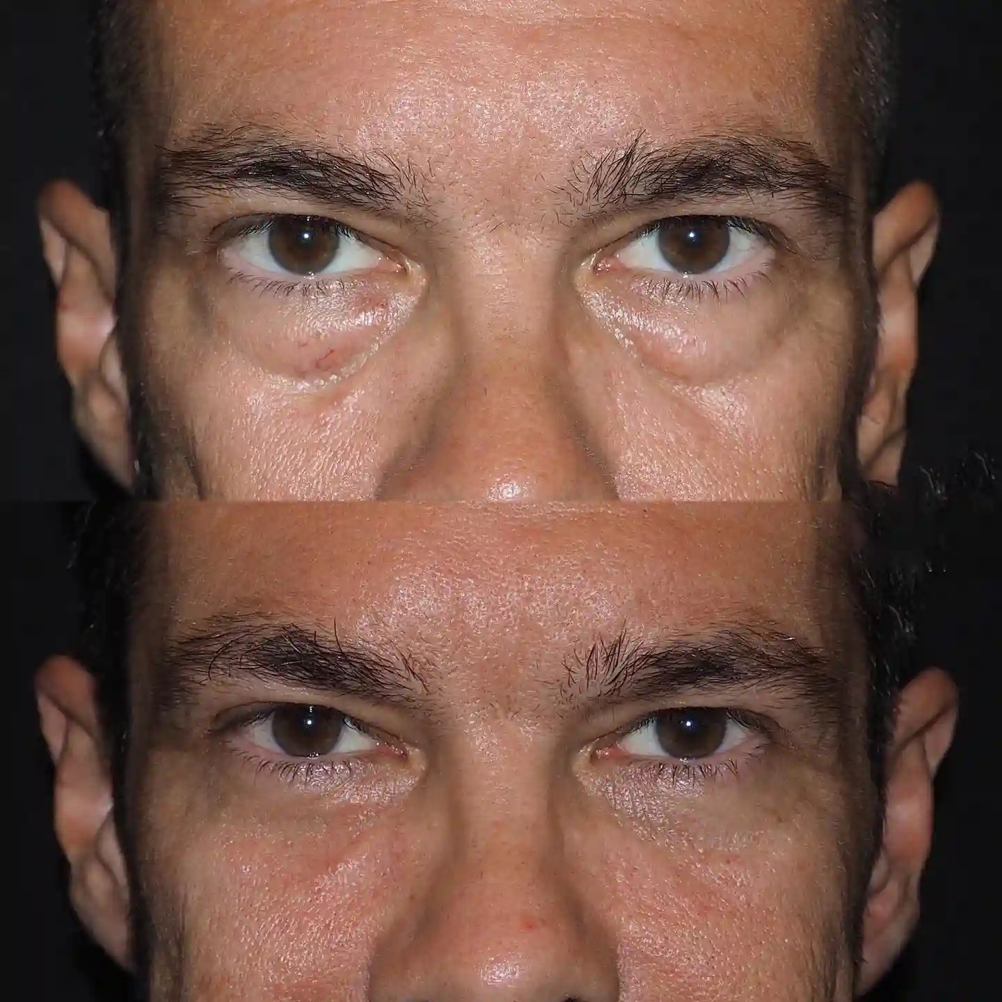 Blepharoplasty Before and After in Turkey-2