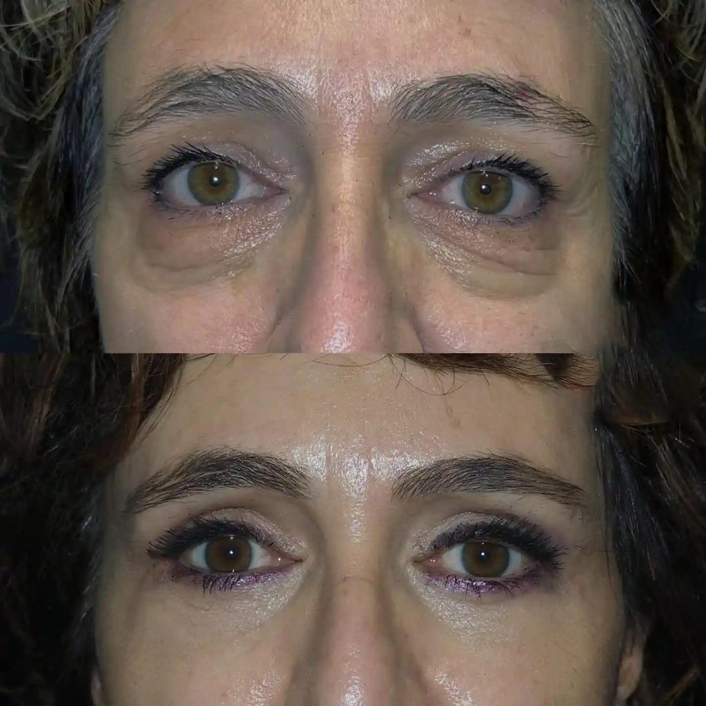 Blepharoplasty Before and After in Turkey-1