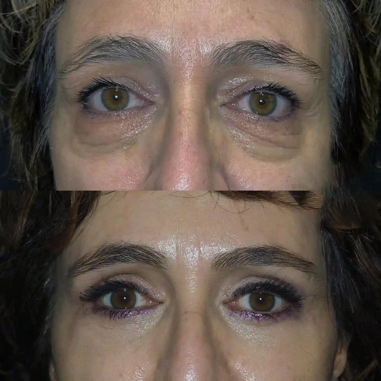 Blepharoplasty Before and After in Turkey-1