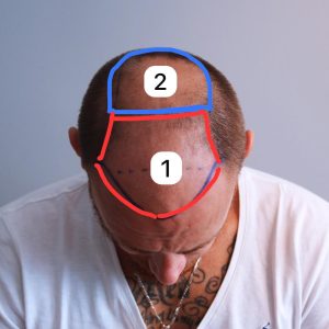 Trapianto di capelli in due sessioni