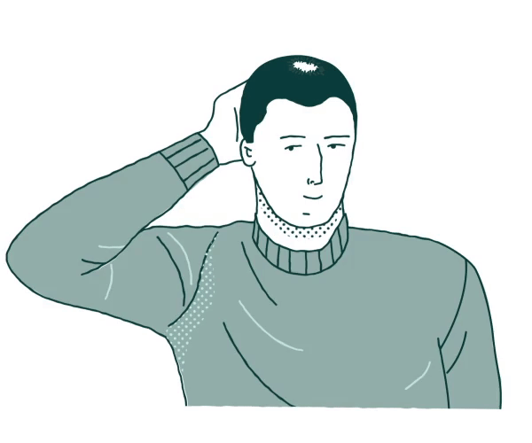 Cosa succede dopo il terzo mese di trapianto di capelli?