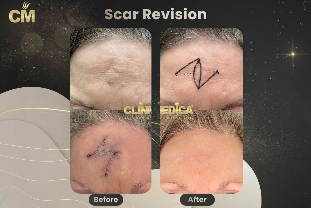 Lip Burn Scar Revision Surgery Ukyo Infoupdate Lip Burn Scar Revision Surgery Ukyo Infoupdate