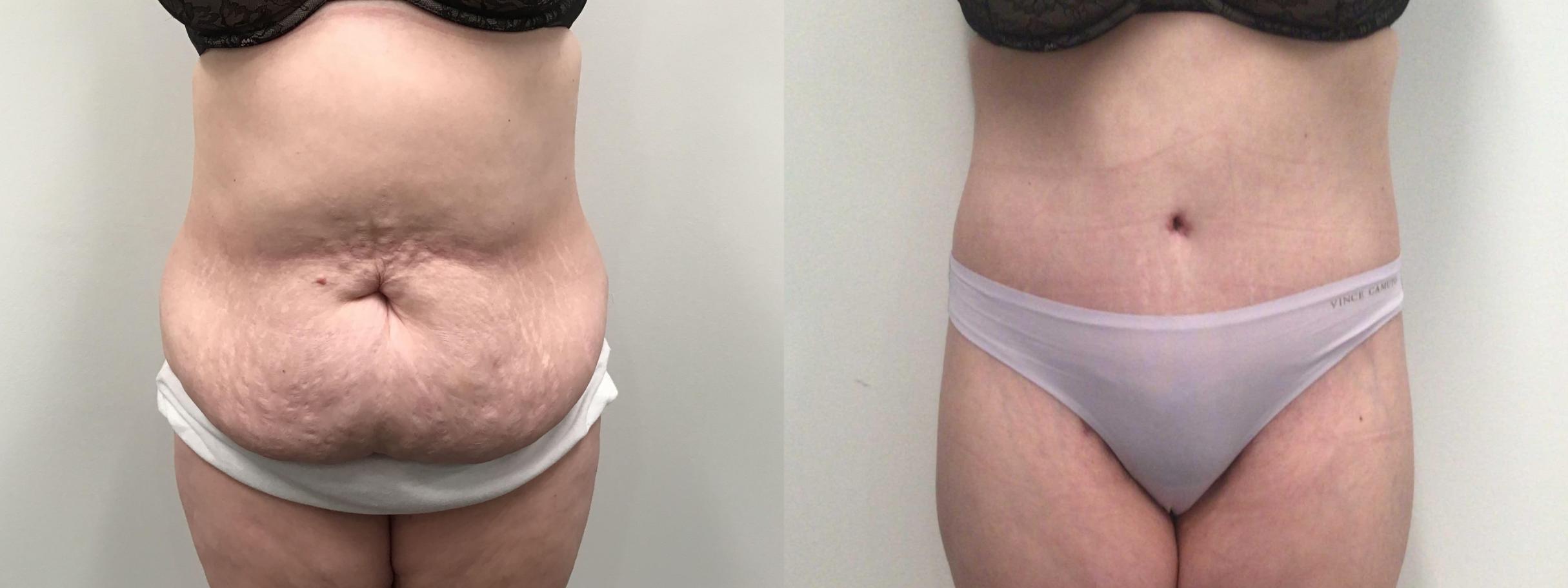 Why Do I Need Body Contouring After Weight Loss?
