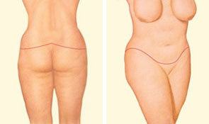 Internal sutures reinforce the reshaped contours