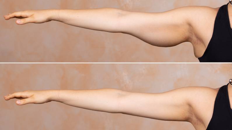 Safe and Effective Arm Lift Surgery in Istanbul