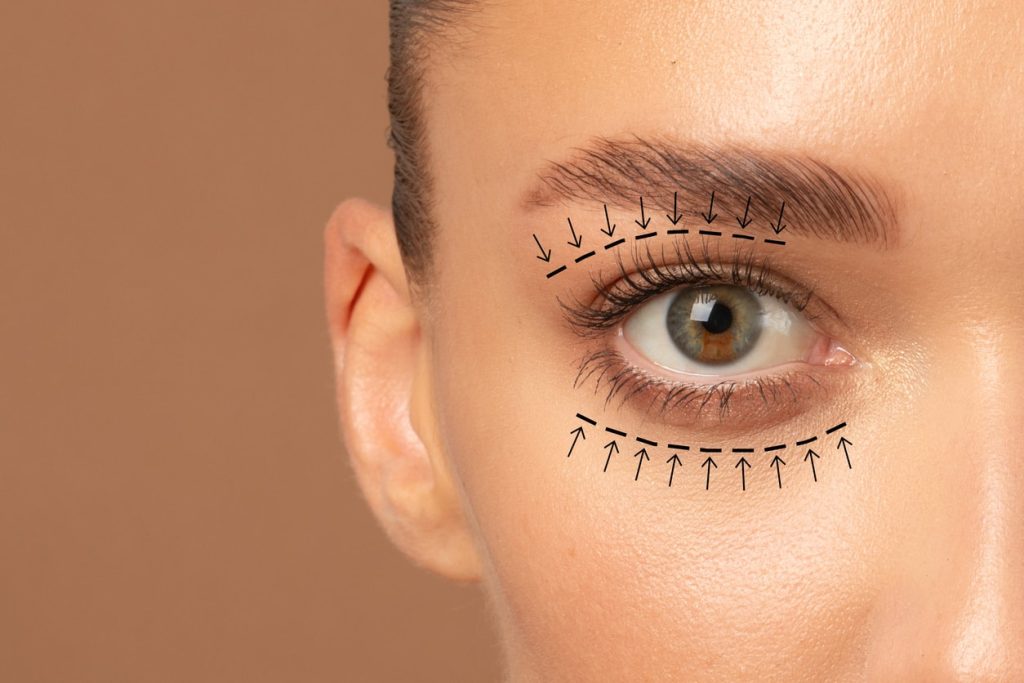 Eyelid Surgery (Blepharoplasty)