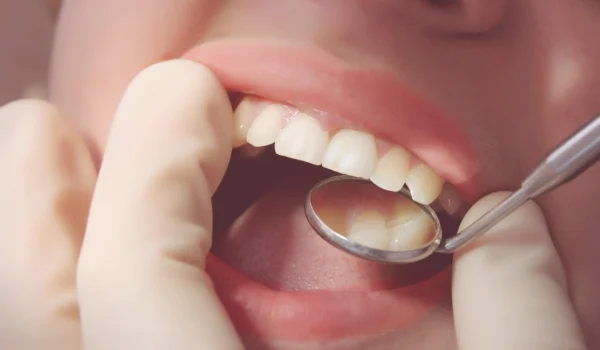Composite Fillings