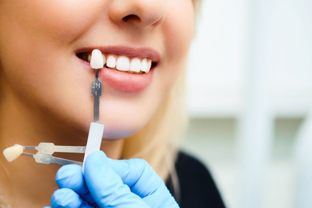 Dental Veneers