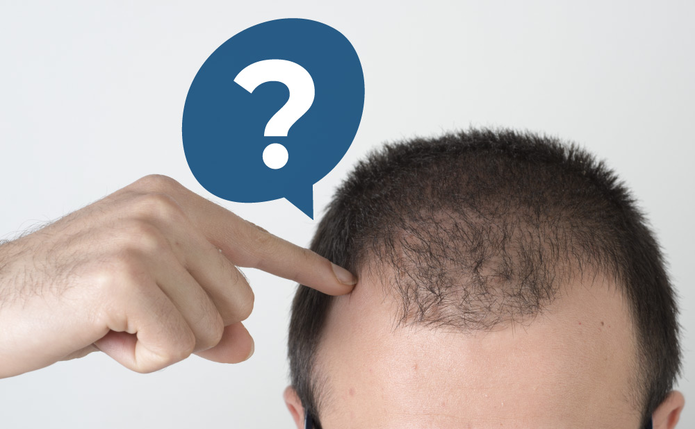 FAQ About Hair Transplant