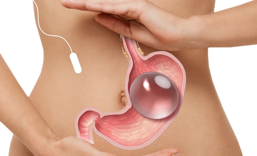 Gastric Balloon Procedure