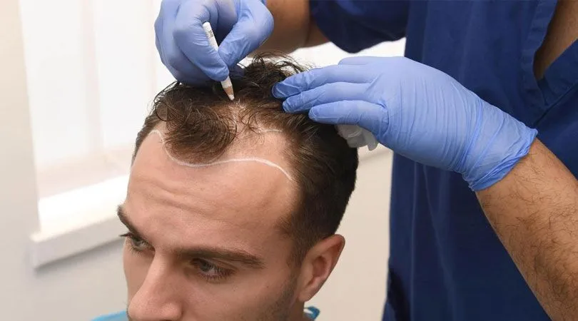 Hairline transplant in Turkey