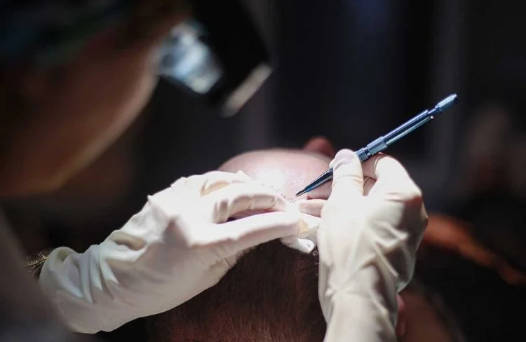 Sapphire FUE hair transplant incisions using sapphire blade