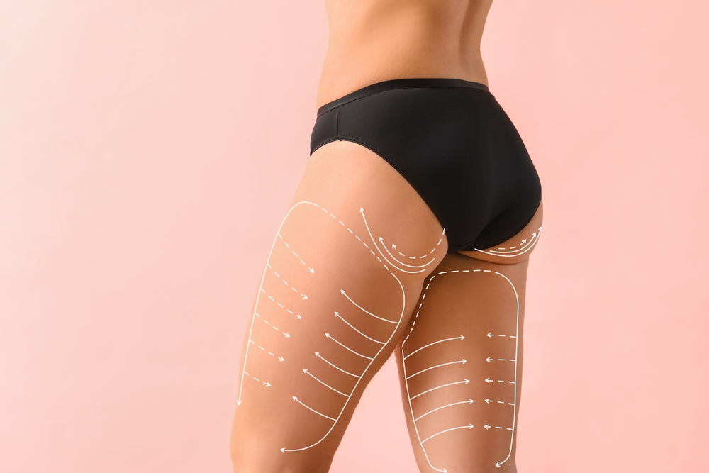 Professional Thigh Lift in Istanbul for a Toned Look