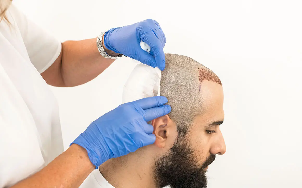 pre-and-post-hair-transplant