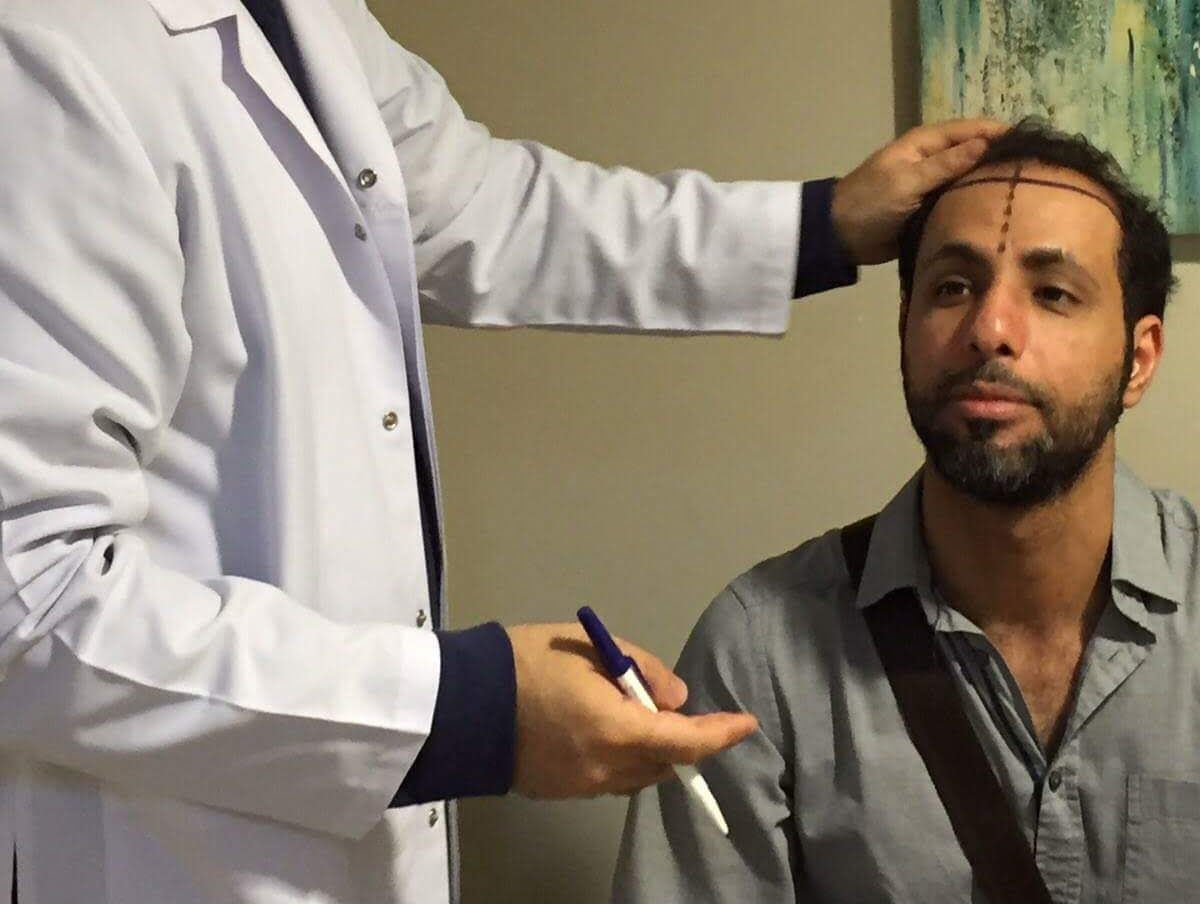 Ön saç çizgisi ekiminden önce saç çizgisi tasarımını kontrol eden doktor