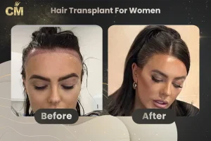 No-shave-hair-transplant-For-women-Before-After