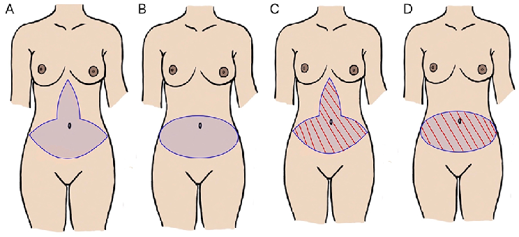 Fleur De Lis Abdominoplasty, Fleur De Lis Tummy Tuck in Turkey