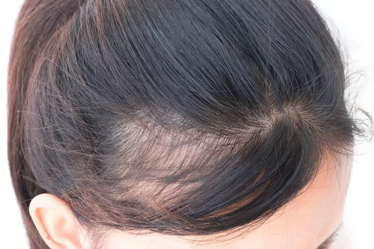 Causes of hair loss in women over 30