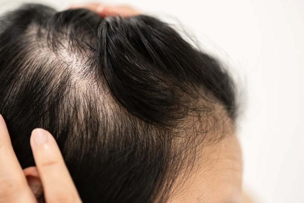 Causes of hair loss in women over 50